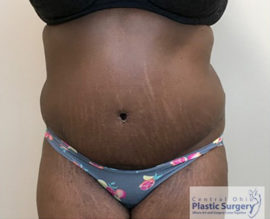 Tummy Tuck