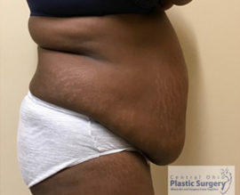 Tummy Tuck