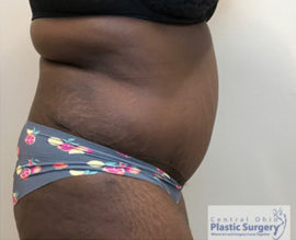 Tummy Tuck