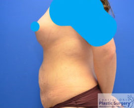 Tummy Tuck