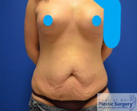 Tummy Tuck