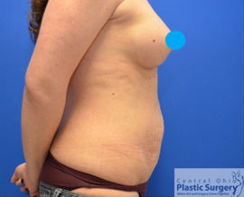 Tummy Tuck