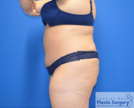 Tummy Tuck