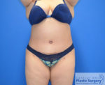 Tummy Tuck