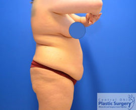 Tummy Tuck