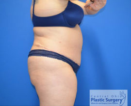 Tummy Tuck