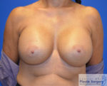 Breast Augmentation