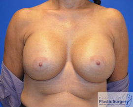Breast Augmentation