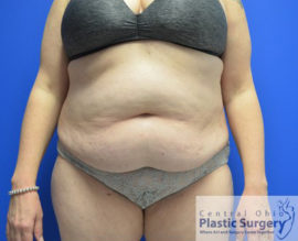 Tummy Tuck