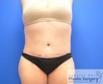 Tummy Tuck