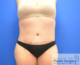 Tummy Tuck