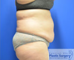 Tummy Tuck