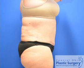 Tummy Tuck