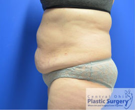 Tummy Tuck