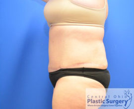 Tummy Tuck