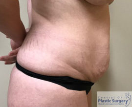 Tummy Tuck