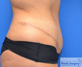 Tummy Tuck