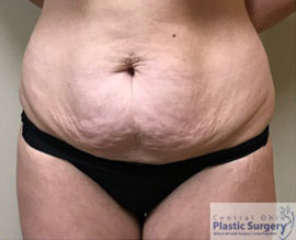 Tummy Tuck