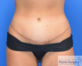 Tummy Tuck