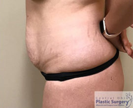 Tummy Tuck