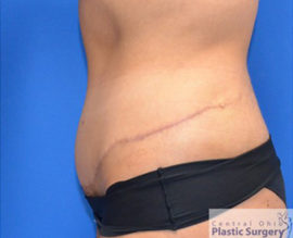 Tummy Tuck