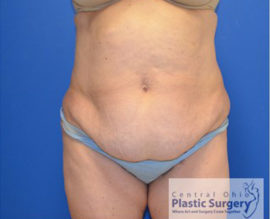 Tummy Tuck