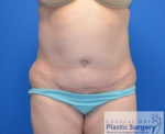 Tummy Tuck