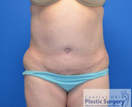 Tummy Tuck