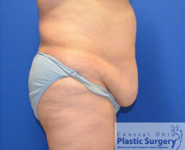 Tummy Tuck