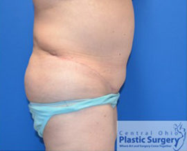 Tummy Tuck