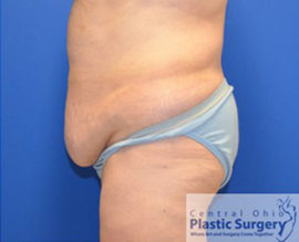 Tummy Tuck