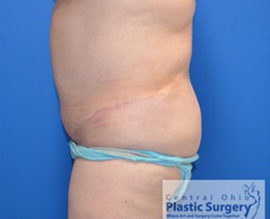 Tummy Tuck