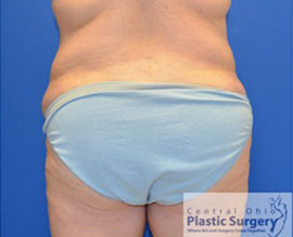 Tummy Tuck