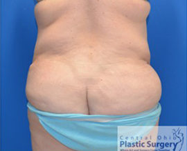 Tummy Tuck