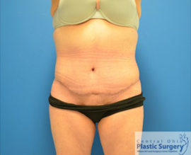 Tummy Tuck