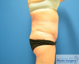 Tummy Tuck