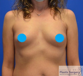 Breast Augmentation