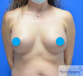 Breast Augmentation