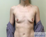 Breast Augmentation