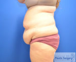 Tummy Tuck