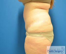 Tummy Tuck