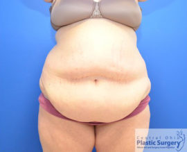 Tummy Tuck