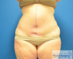 Tummy Tuck