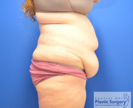 Tummy Tuck