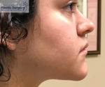 Liposuction (Neck)