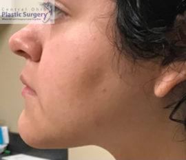 Liposuction (Neck)