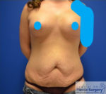 Breast Augmentation