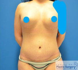 Breast Augmentation