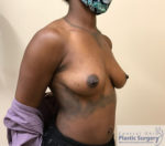 Breast Augmentation