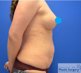 Breast Augmentation